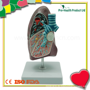 Pädagogische Demonstrationserkrankung Lunge Anatomisches Modell